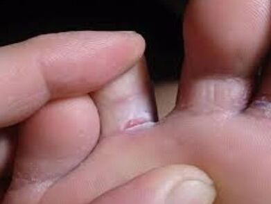 Has a toe fungus