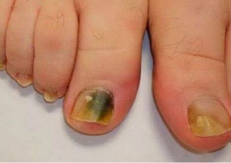 Infection affects the nail plates