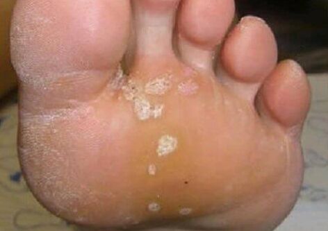 Mushroom skin lesions