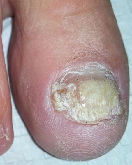 The sponge on the legs