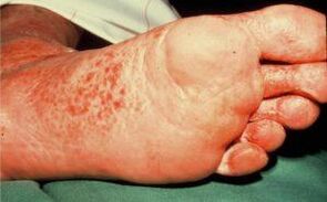 Sponge on the foot of gastric ulcer