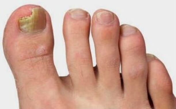The fungus on the thumbs of the leg