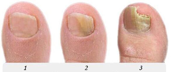 The process of developing the fungus on the thumb