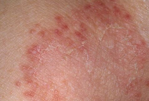 How to quickly heal the fungus, the doctor will tell