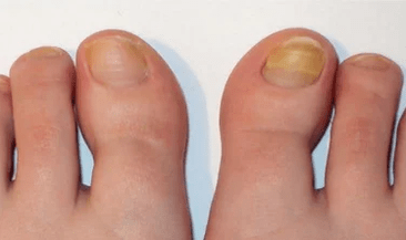 The initial phase of nail the fungus
