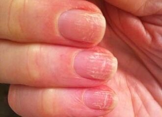 The initial phase of the fungus on the nails