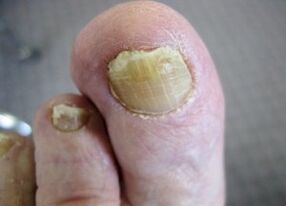 The causes of the fungus's appearance on the nails