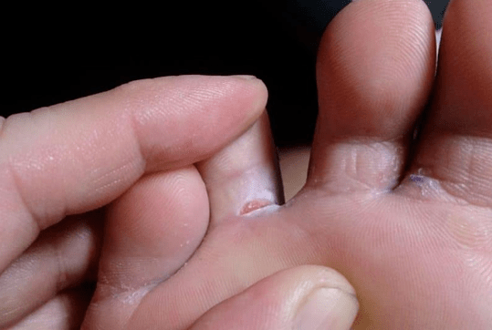The appearance of bubble formations on the feet