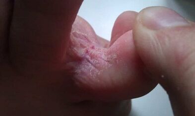 Phases of the development of the fungus between the toes