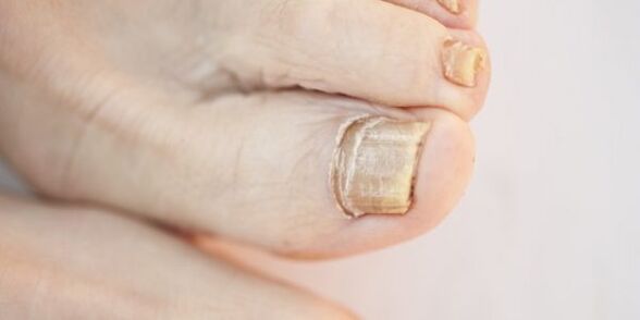 damage to the nail plates of the toes due to fungus