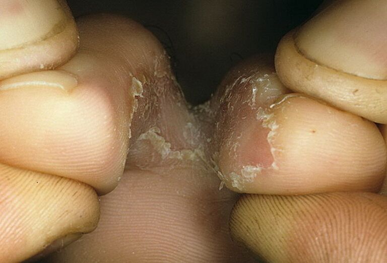 Intertriginous form of fungus