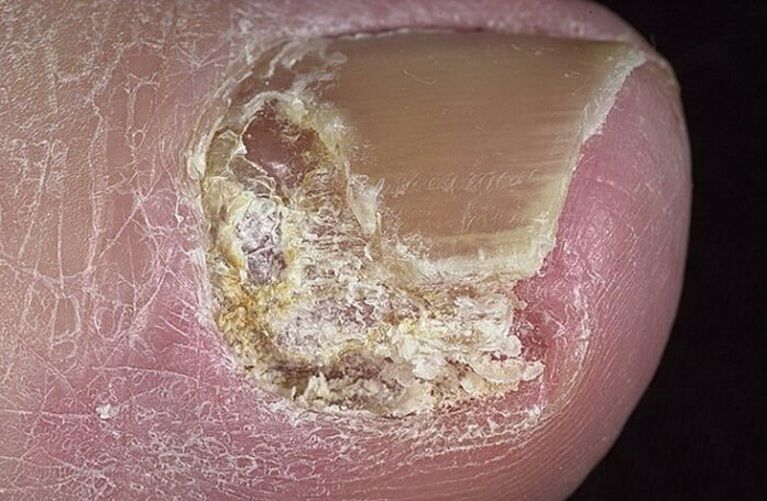 Types of onychomycosis