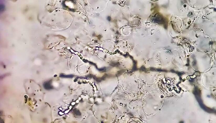 Fungi under a microscope - the culprit in the development of mycosis of the feet