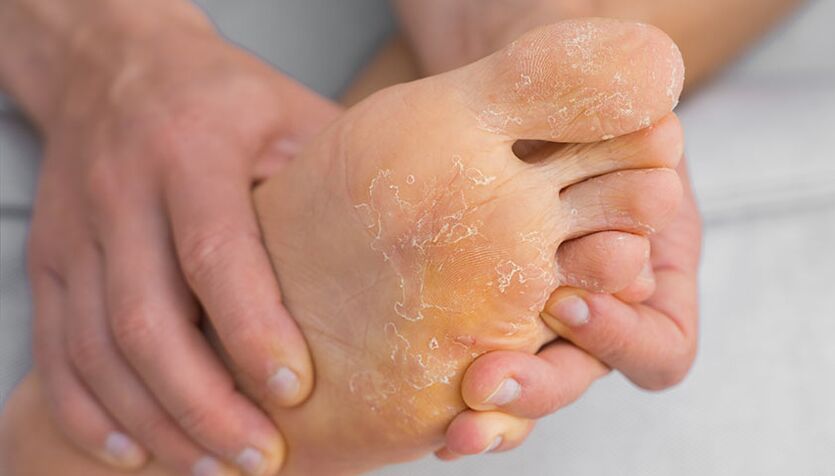 Peeling skin and itching are symptoms of athlete's foot