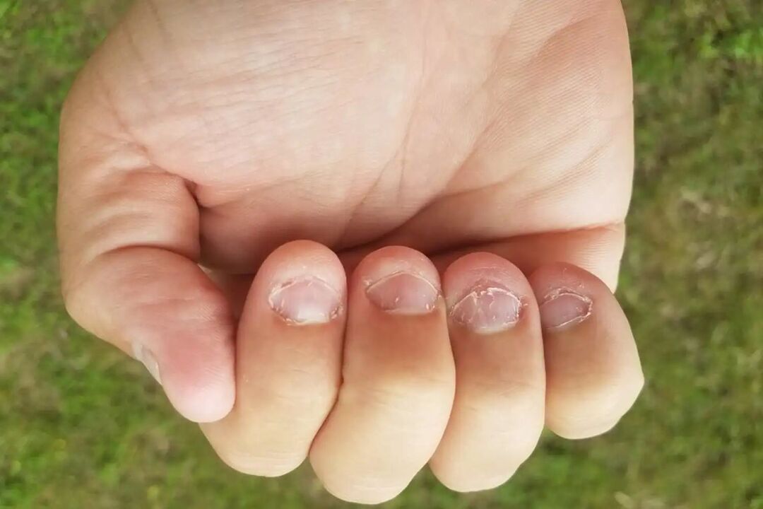 micronykia on nails