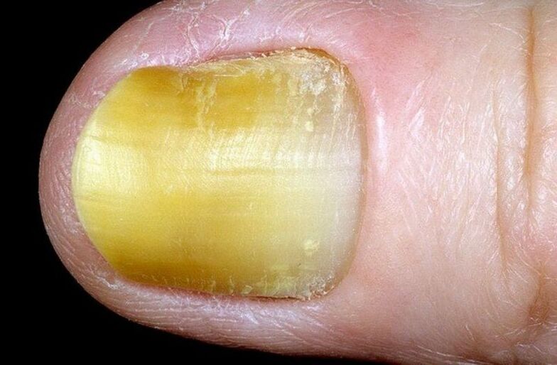 onycholysis of nails