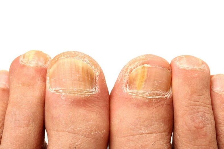 onychomycosis on nails